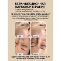 Карбокситерапия для кожи лица, шеи, декольте