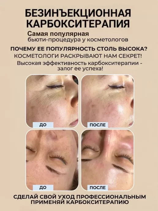 Карбокситерапия для кожи лица, шеи, декольте