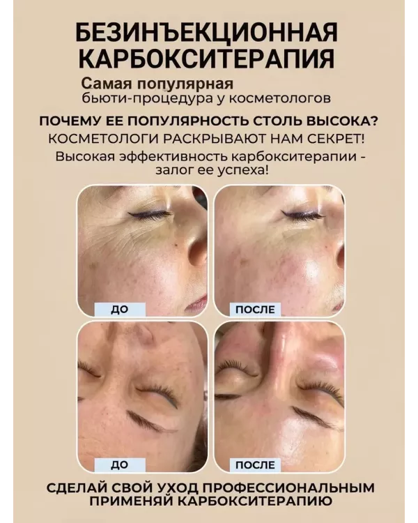 Карбокситерапия для кожи лица, шеи, декольте